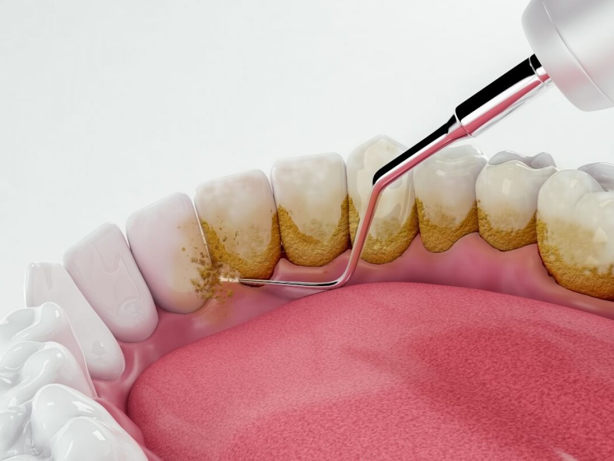 Limpieza dental